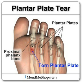 plantar plate tear plantar plate tear